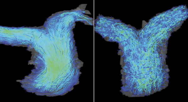 Medical images showing blood flow through pulmonary artery.